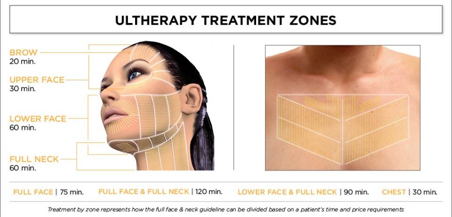 Ultherapy Treatment Zones