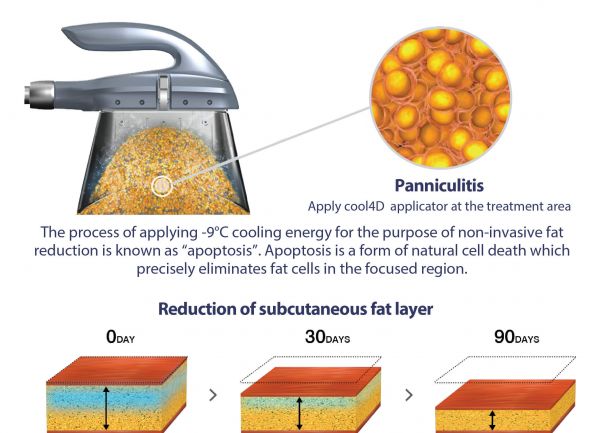 Skinaa Clinic on X: #Fatfreezing- Is a non-invasive cosmetic procedure  designed to reduce localized pockets of fat by #freezing the fat cells.  Optimize fat freezing outcomes with these habits: Stay #hydrated, maintain